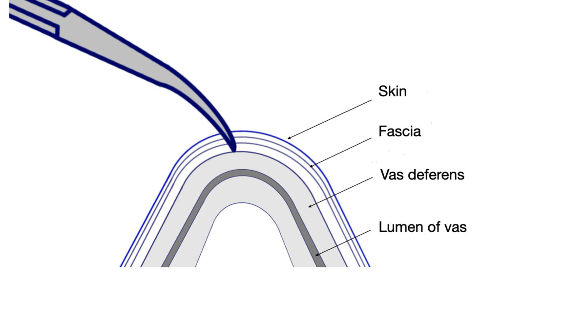 The first puncture – Vasectomy Resources